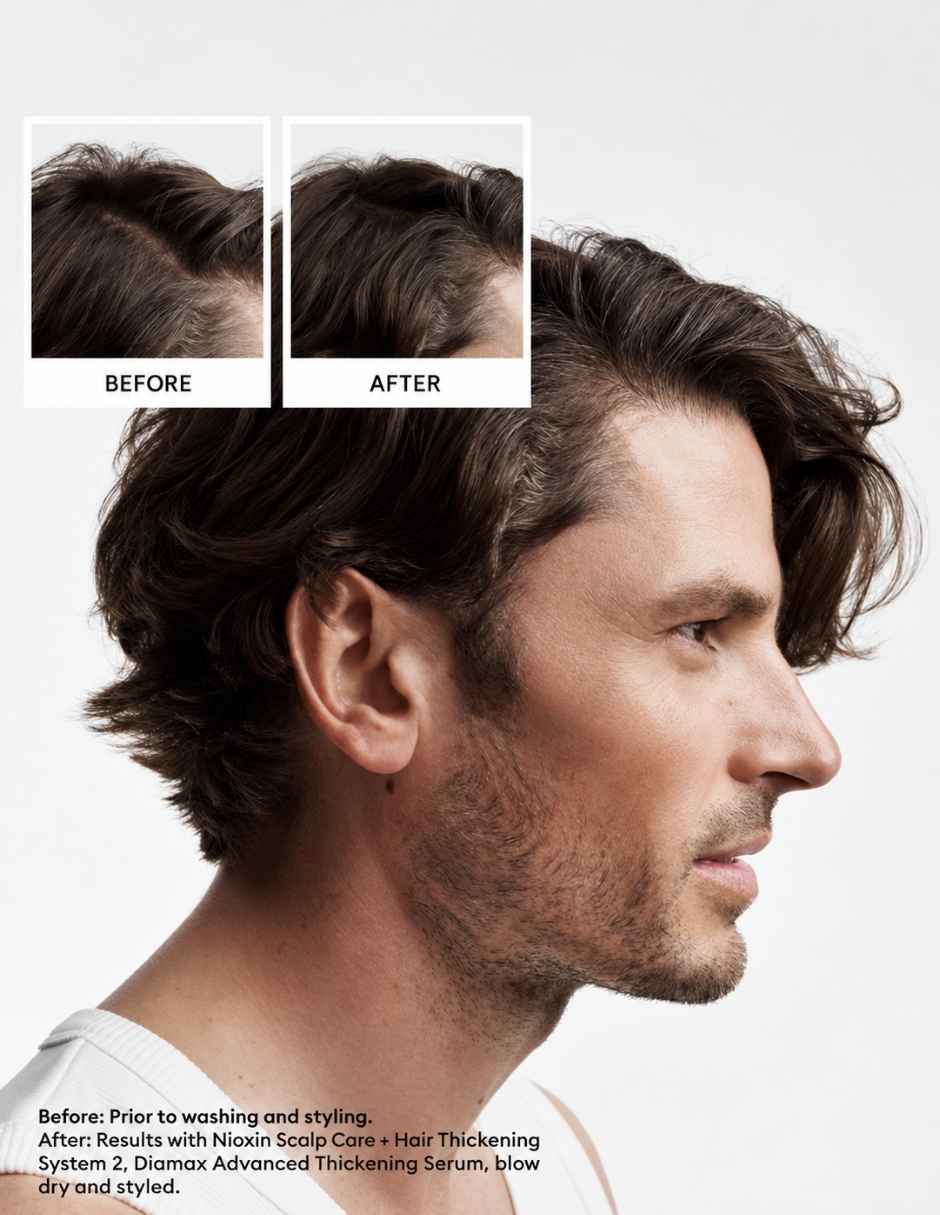 Tratamiento para cuero cabelludo tratamiento sistema 2 para cuero cabelludo y cabello con debilitamiento avanzado anticaída Nioxin 2